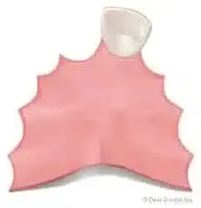 1-2 Tooth Replacement Acrylic Partial - Dentist Directed - Impression Kit Included - Image 10