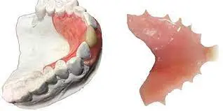 1-2 Tooth Replacement Acrylic Partial - Dentist Directed - Impression Kit Included - Image 12