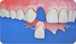 1-2 Tooth Replacement Acrylic Partial - Dentist Directed - Impression Kit Included - Image 5