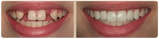 1-2 Tooth Replacement Acrylic Partial - Dentist Directed - Impression Kit Included - Image 6