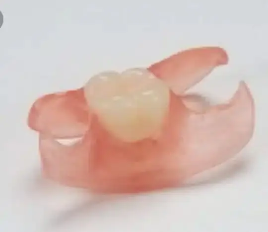 Unilateral Partial 1-3 Teeth - Dentist Directed - Impression Kit Included - Image 7